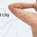 Bacolod confirms first MPOX case