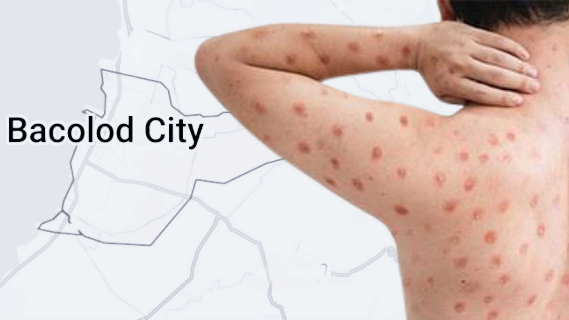 Bacolod confirms first MPOX case