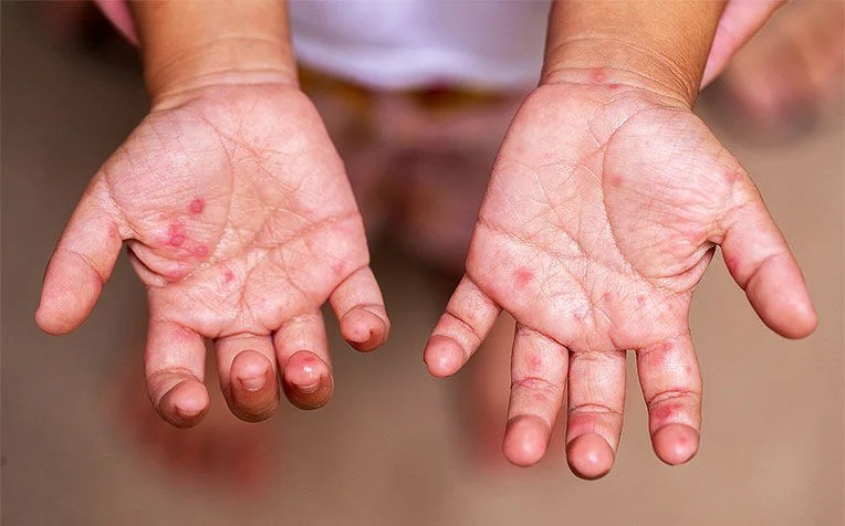 NegOcc logs over 800 Hand, Foot, and Mouth cases